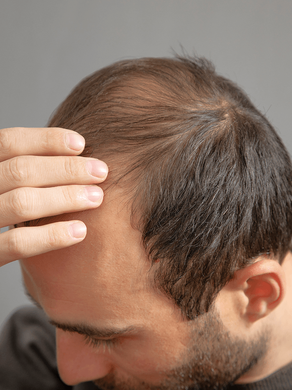 thinning hair example