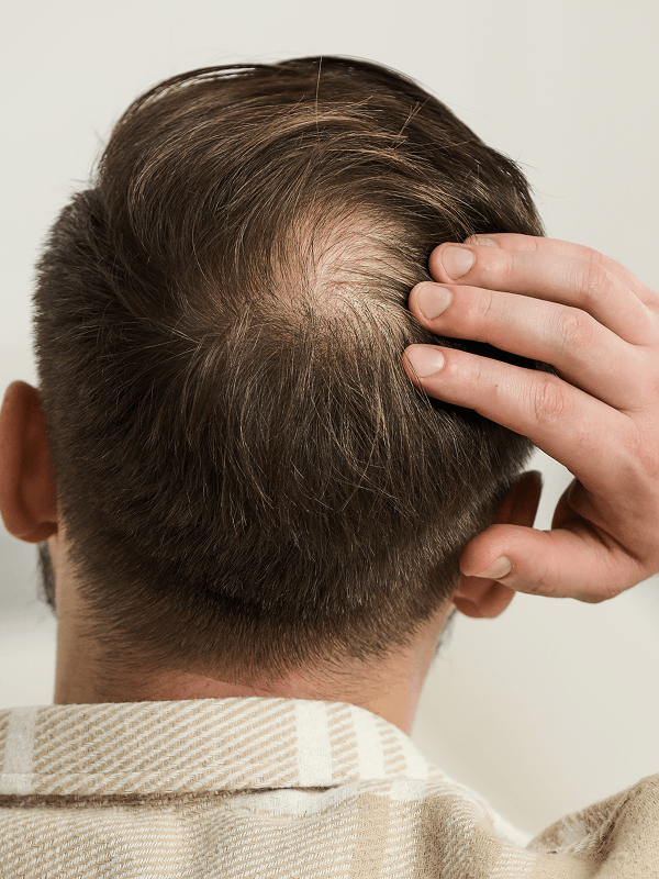 thinning hair example